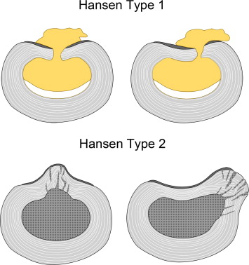 Hansen Types 1 & 2 Herniation
