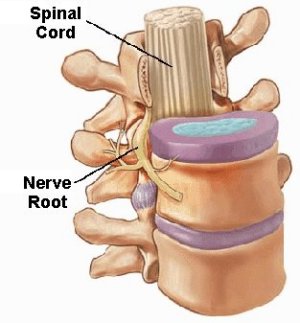 Vertebrae, Disc, & Nerve Root