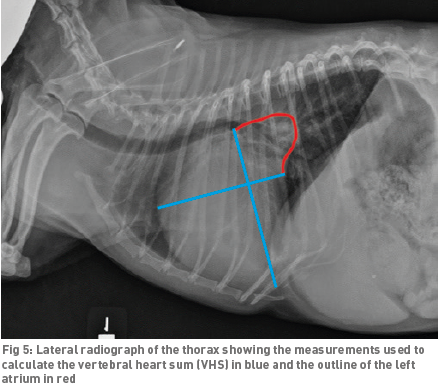 VHS misses enlarged left atrium