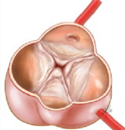 Quadricuspid aortic valve