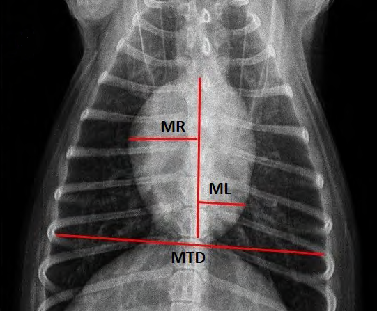 Cardiothoracic Ratio (CTR)