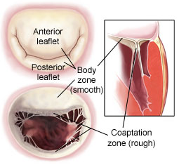 Mitral Valve Coaptation