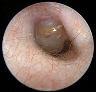 Severe bulging pars flaccida obscuring pars tensa in CKCS