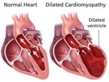 Dilated Cardiomyopathy