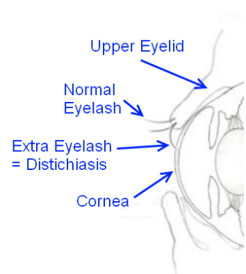 Distichiasis Diagram