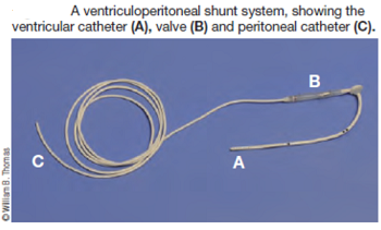 ventriculoperitoneal shunt