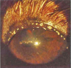 Meibomianitis in a CKCS