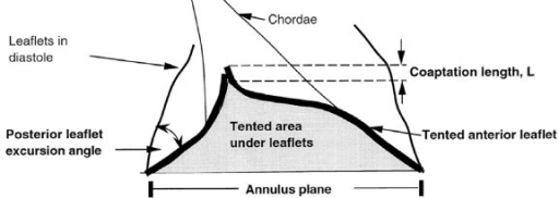 Mitral Valve Tenting