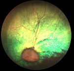 Retinal Atrophy