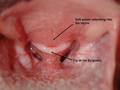 Soft Palate & Epiglottis
