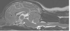 Chiari-like malformation