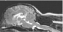 Descent of indented cerebellum