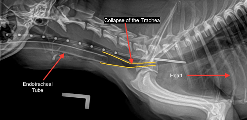 Collapsed trachea