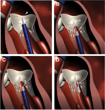 V-clamp device